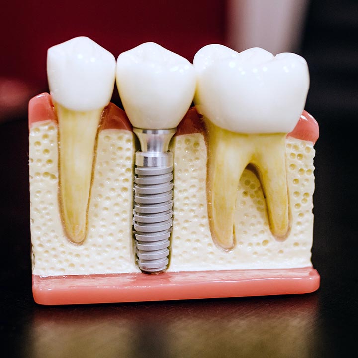 Chirugia e Implantologia