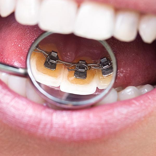 Ortodonzia Linguale